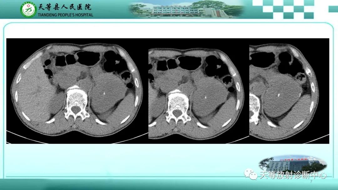 影像PPT - 【病例】脾脏假性动脉瘤1例CT影像-7 影像PPT - 【病例】脾脏假性动脉瘤1例CT影像-7