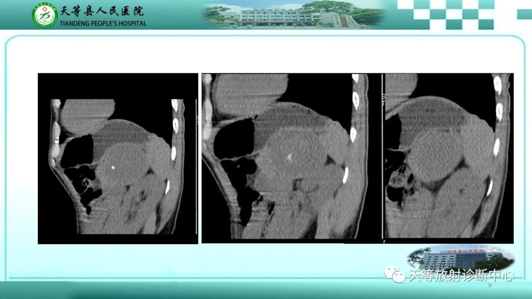 影像PPT - 【病例】脾脏假性动脉瘤1例CT影像-9 影像PPT - 【病例】脾脏假性动脉瘤1例CT影像-9