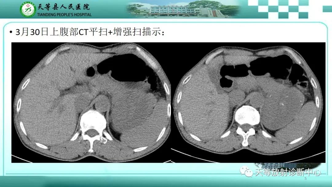 影像PPT - 【病例】脾脏假性动脉瘤1例CT影像-5 影像PPT - 【病例】脾脏假性动脉瘤1例CT影像-5