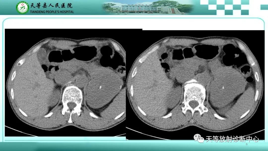 影像PPT - 【病例】脾脏假性动脉瘤1例CT影像-6 影像PPT - 【病例】脾脏假性动脉瘤1例CT影像-6