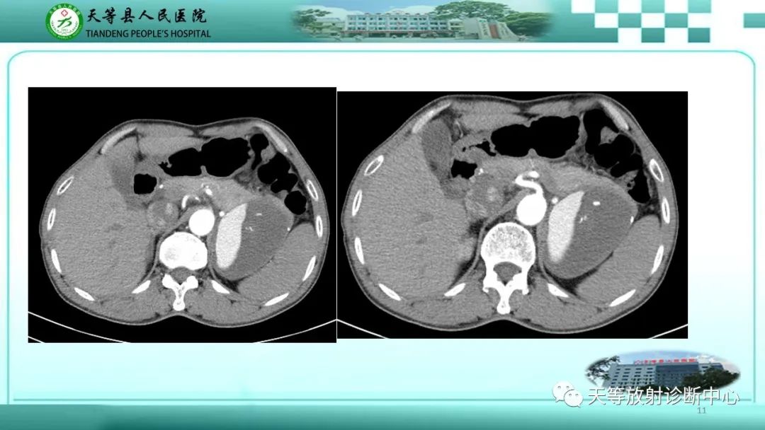 影像PPT - 【病例】脾脏假性动脉瘤1例CT影像-11 影像PPT - 【病例】脾脏假性动脉瘤1例CT影像-11