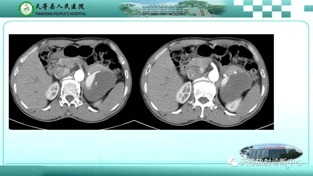 影像PPT - 【病例】脾脏假性动脉瘤1例CT影像-12 影像PPT - 【病例】脾脏假性动脉瘤1例CT影像-12