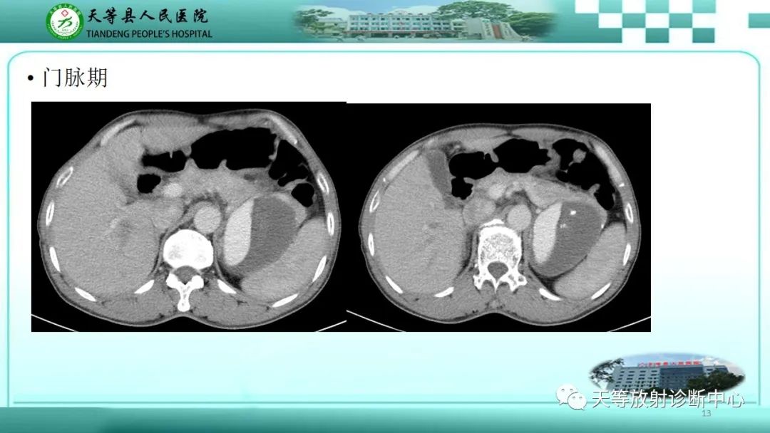影像PPT - 【病例】脾脏假性动脉瘤1例CT影像-13 影像PPT - 【病例】脾脏假性动脉瘤1例CT影像-13