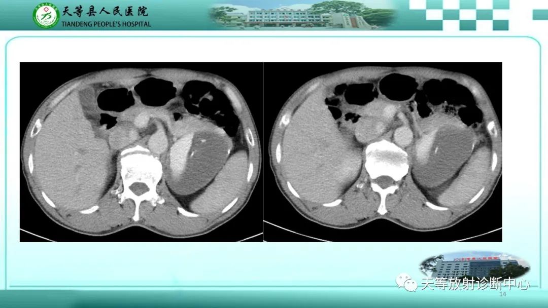影像PPT - 【病例】脾脏假性动脉瘤1例CT影像-14 影像PPT - 【病例】脾脏假性动脉瘤1例CT影像-14