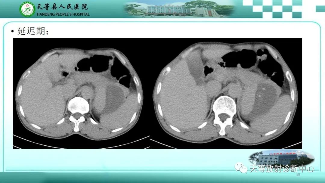 影像PPT - 【病例】脾脏假性动脉瘤1例CT影像-15 影像PPT - 【病例】脾脏假性动脉瘤1例CT影像-15
