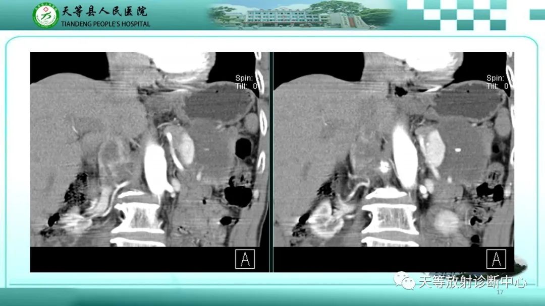 影像PPT - 【病例】脾脏假性动脉瘤1例CT影像-17 影像PPT - 【病例】脾脏假性动脉瘤1例CT影像-17