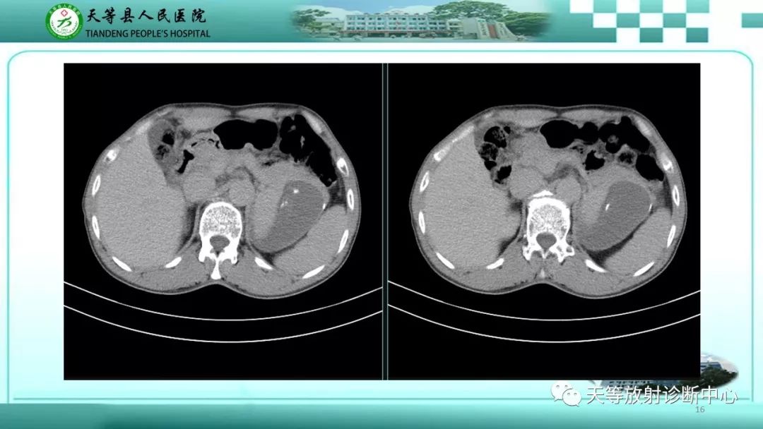 影像PPT - 【病例】脾脏假性动脉瘤1例CT影像-16 影像PPT - 【病例】脾脏假性动脉瘤1例CT影像-16