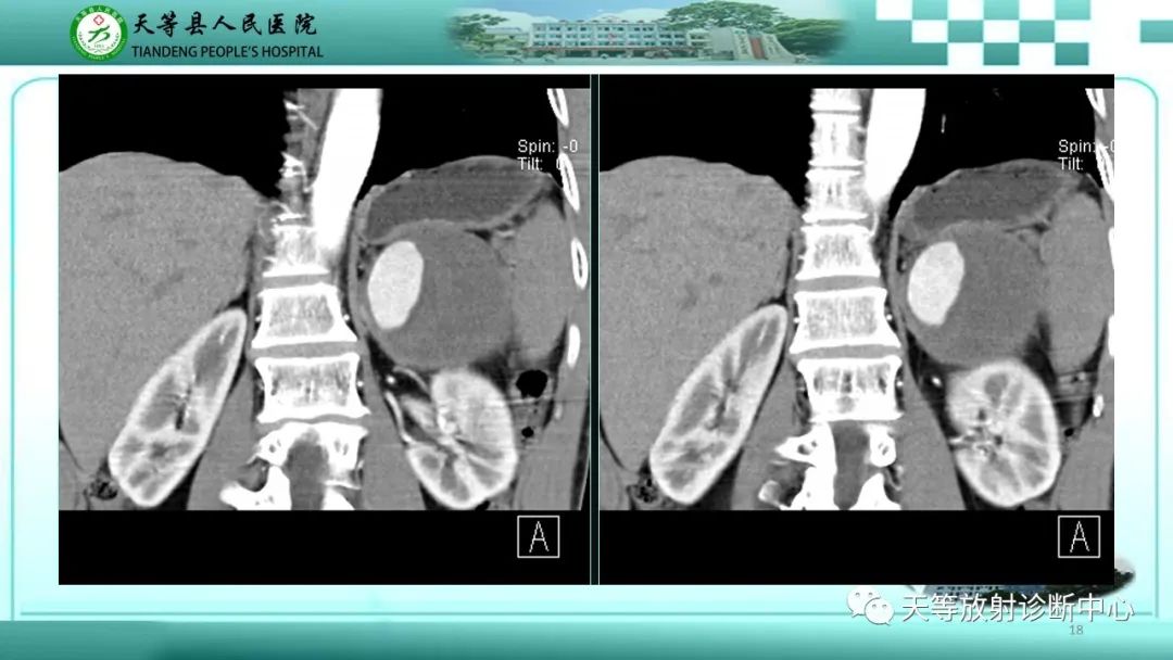影像PPT - 【病例】脾脏假性动脉瘤1例CT影像-18 影像PPT - 【病例】脾脏假性动脉瘤1例CT影像-18