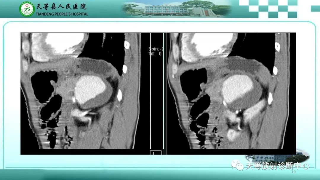影像PPT - 【病例】脾脏假性动脉瘤1例CT影像-19 影像PPT - 【病例】脾脏假性动脉瘤1例CT影像-19
