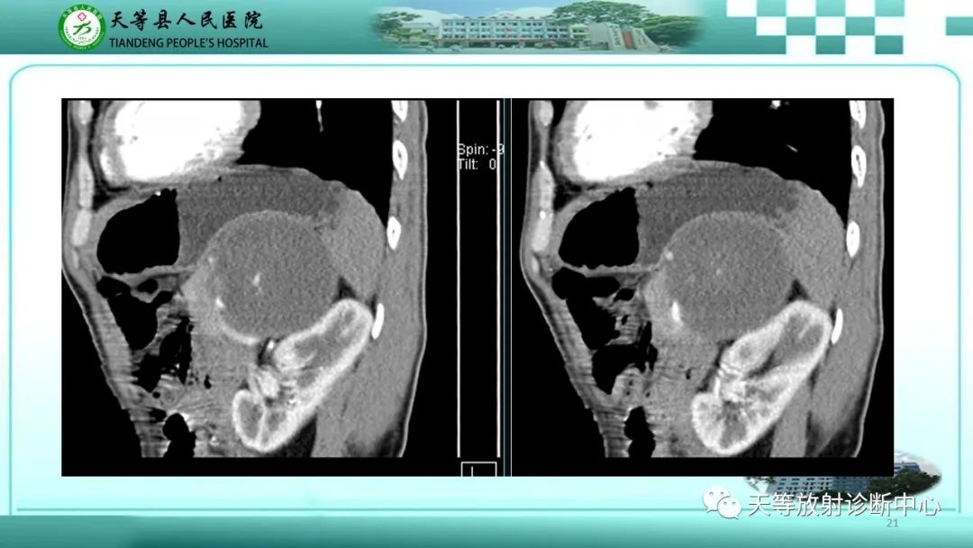 影像PPT - 【病例】脾脏假性动脉瘤1例CT影像-21 影像PPT - 【病例】脾脏假性动脉瘤1例CT影像-21