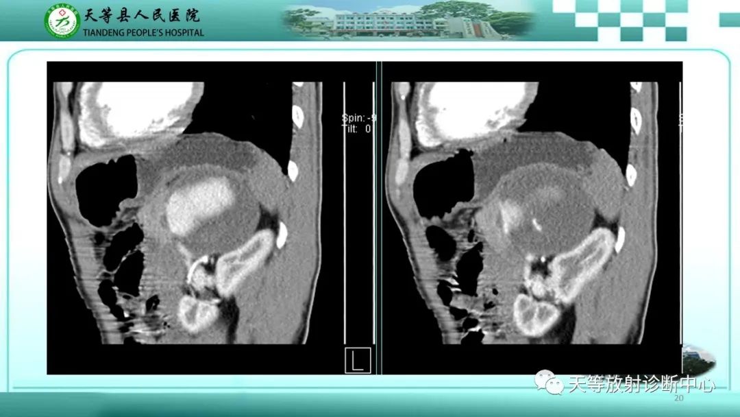 影像PPT - 【病例】脾脏假性动脉瘤1例CT影像-20 影像PPT - 【病例】脾脏假性动脉瘤1例CT影像-20