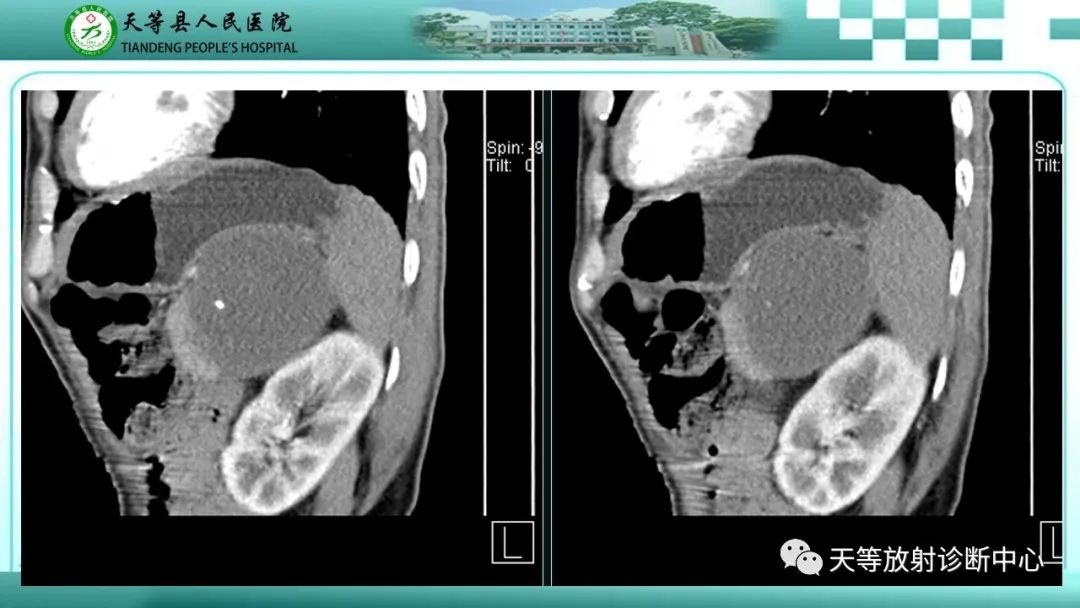 影像PPT - 【病例】脾脏假性动脉瘤1例CT影像-22 影像PPT - 【病例】脾脏假性动脉瘤1例CT影像-22