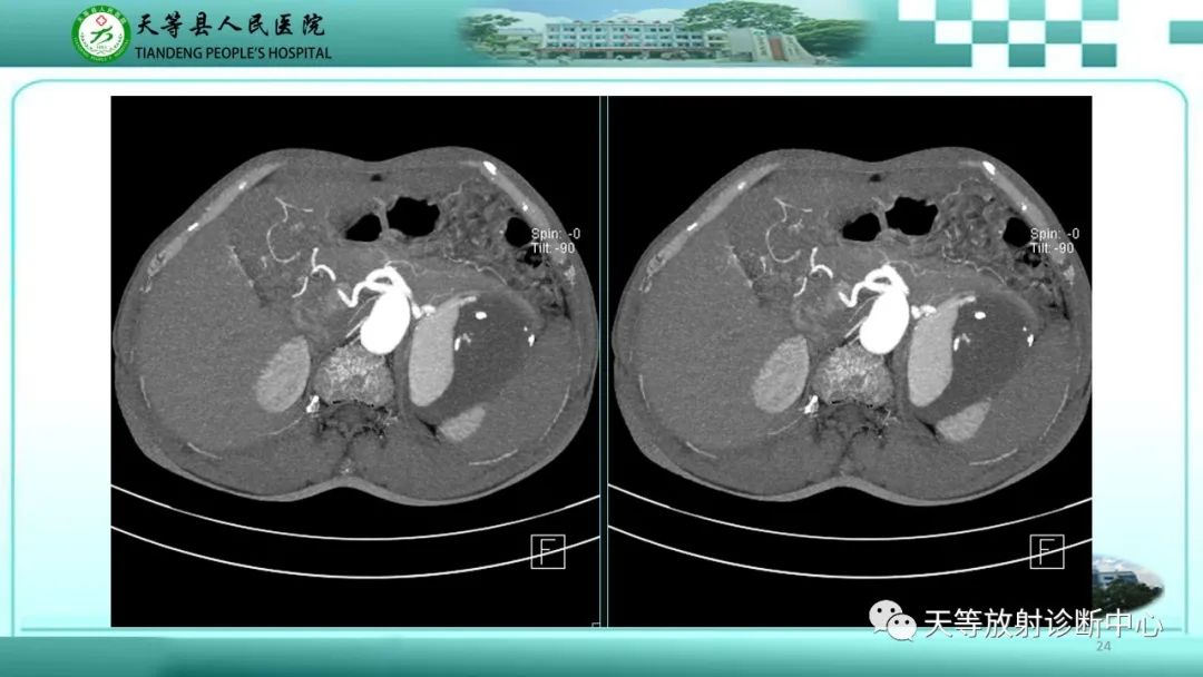影像PPT - 【病例】脾脏假性动脉瘤1例CT影像-24 影像PPT - 【病例】脾脏假性动脉瘤1例CT影像-24
