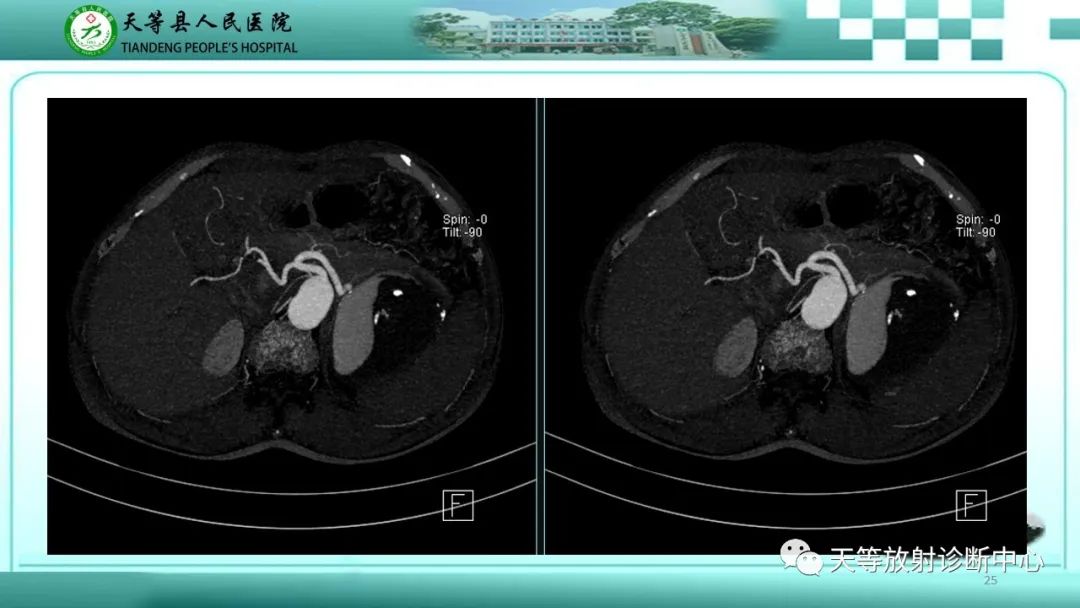 影像PPT - 【病例】脾脏假性动脉瘤1例CT影像-25 影像PPT - 【病例】脾脏假性动脉瘤1例CT影像-25