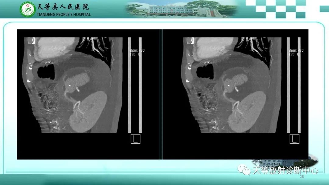 影像PPT - 【病例】脾脏假性动脉瘤1例CT影像-28 影像PPT - 【病例】脾脏假性动脉瘤1例CT影像-28