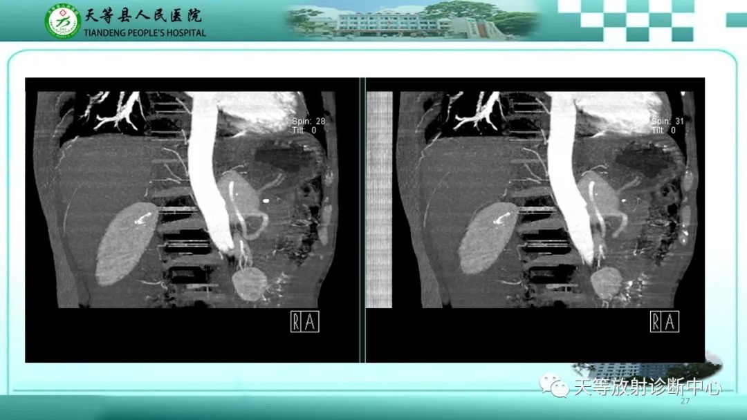 影像PPT - 【病例】脾脏假性动脉瘤1例CT影像-27 影像PPT - 【病例】脾脏假性动脉瘤1例CT影像-27