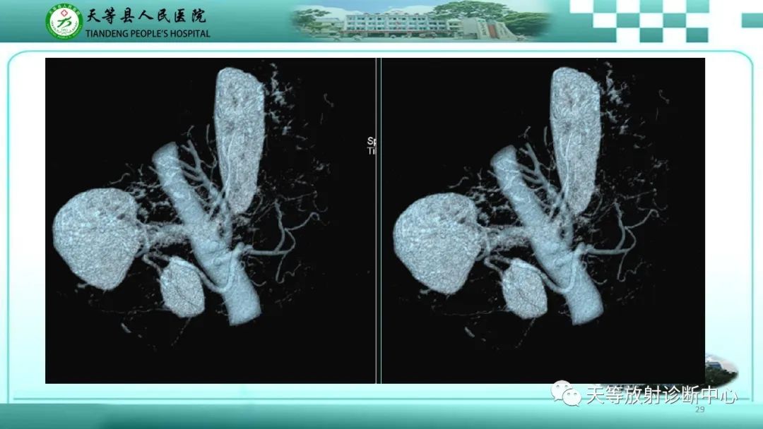 影像PPT - 【病例】脾脏假性动脉瘤1例CT影像-29 影像PPT - 【病例】脾脏假性动脉瘤1例CT影像-29