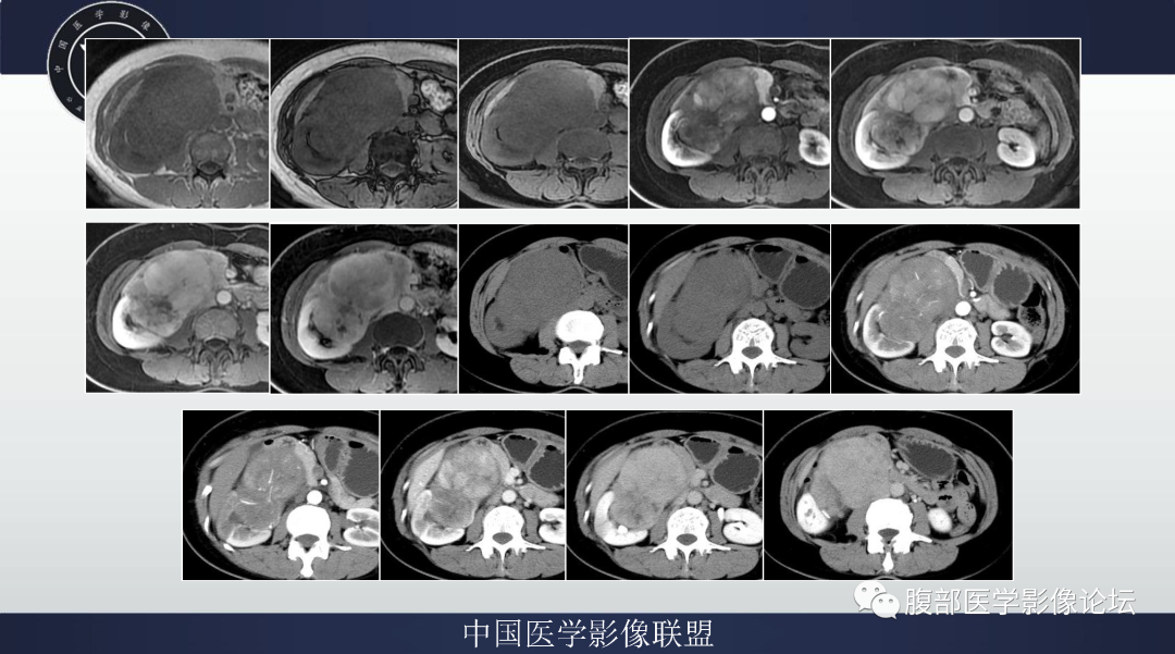 影像PPT - 【病例】肾脏平滑肌肉瘤1例MR影像-3 影像PPT - 【病例】肾脏平滑肌肉瘤1例MR影像-3