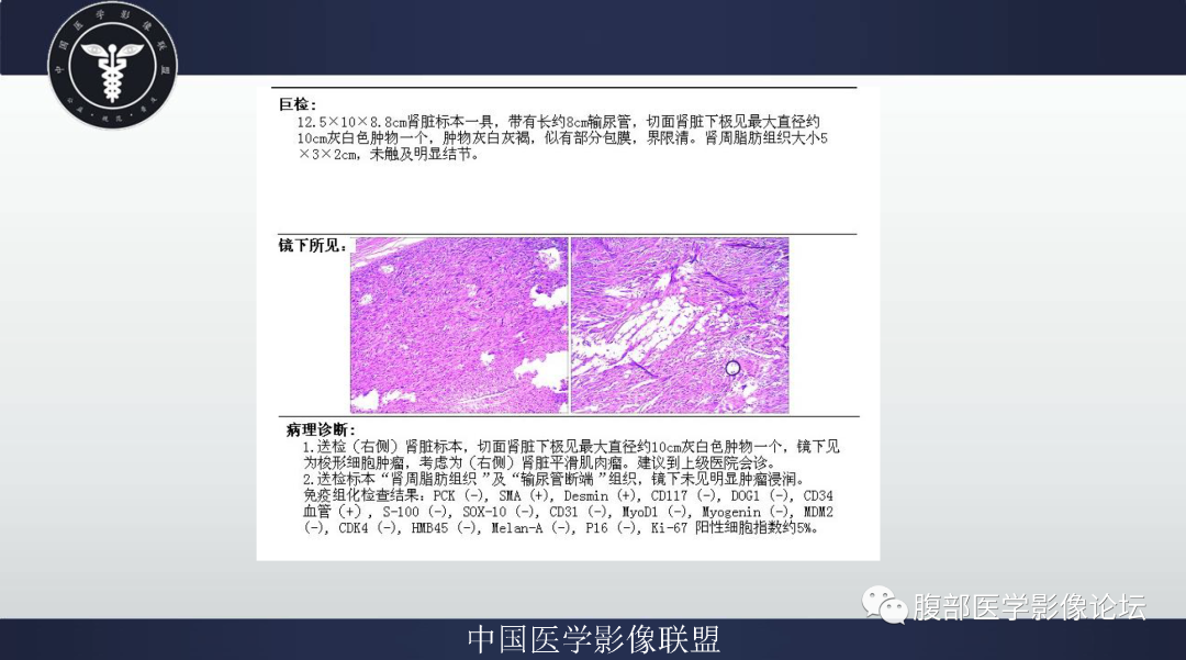 影像PPT - 【病例】肾脏平滑肌肉瘤1例MR影像-4 影像PPT - 【病例】肾脏平滑肌肉瘤1例MR影像-4