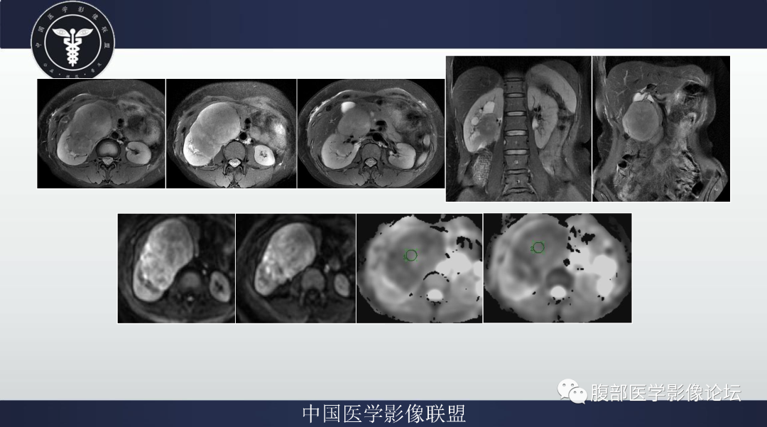 影像PPT - 【病例】肾脏平滑肌肉瘤1例MR影像-2 影像PPT - 【病例】肾脏平滑肌肉瘤1例MR影像-2