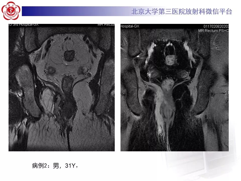 影像PPT - 【PPT】肛瘘-4