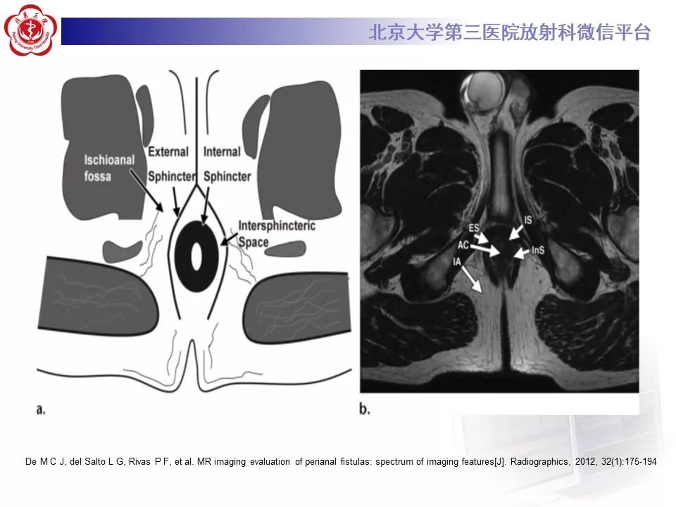 影像PPT - 【PPT】肛瘘-14