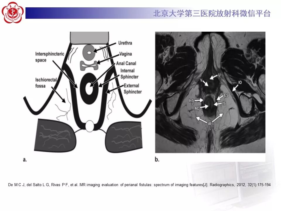 影像PPT - 【PPT】肛瘘-15