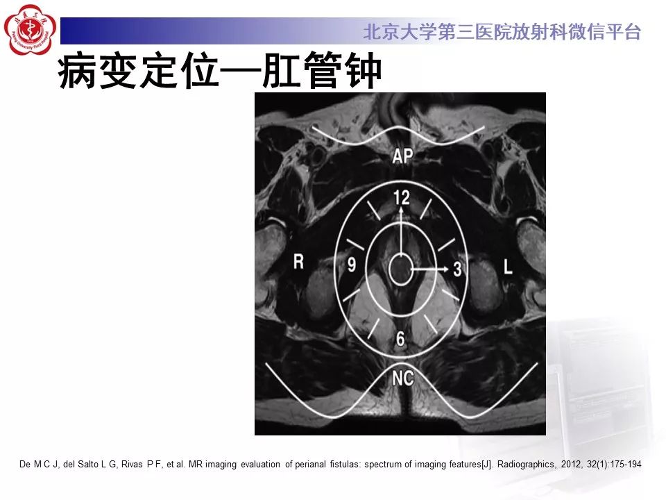 影像PPT - 【PPT】肛瘘-19