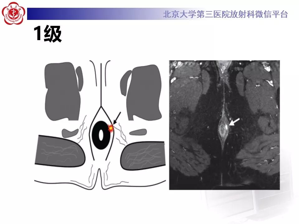 影像PPT - 【PPT】肛瘘-25