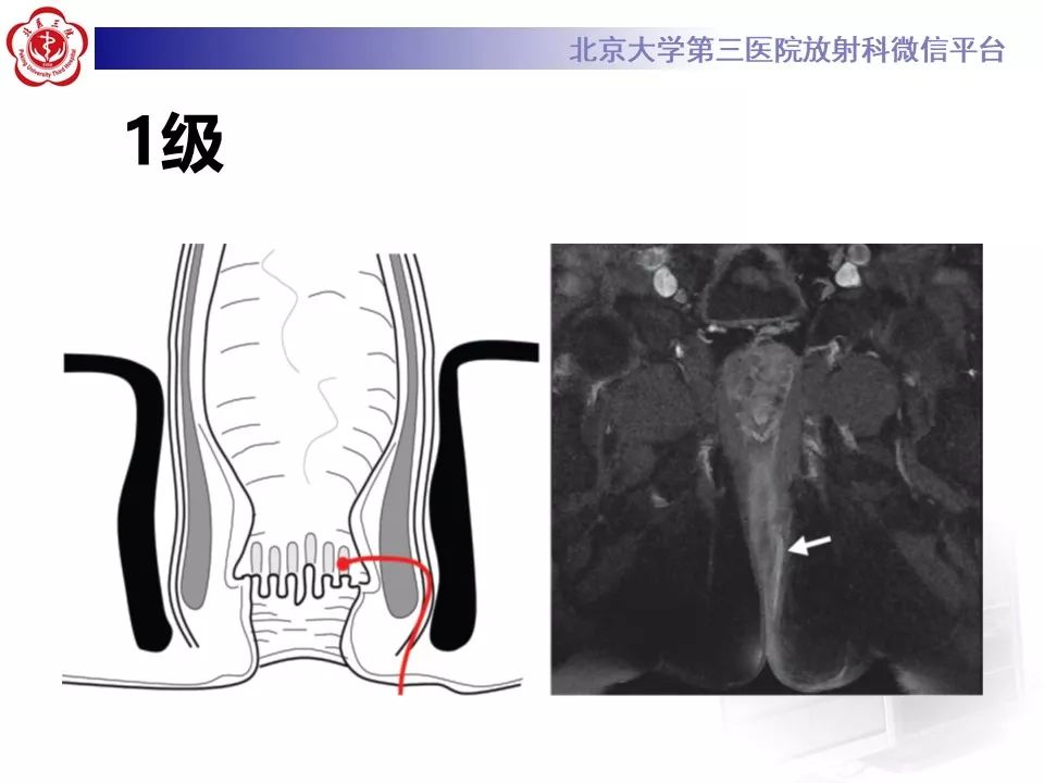 影像PPT - 【PPT】肛瘘-26