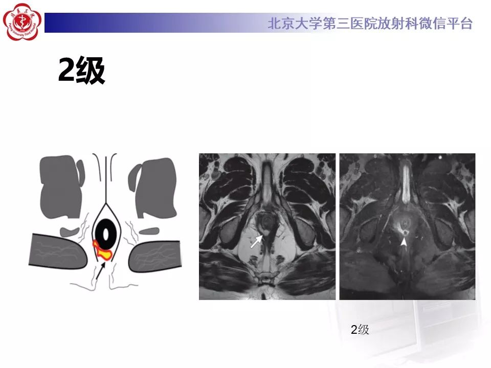 影像PPT - 【PPT】肛瘘-27