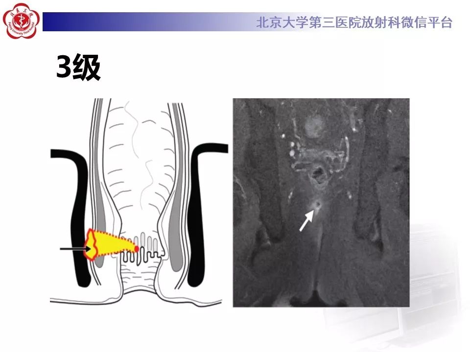 影像PPT - 【PPT】肛瘘-28