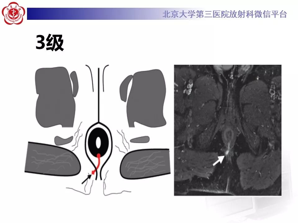影像PPT - 【PPT】肛瘘-29