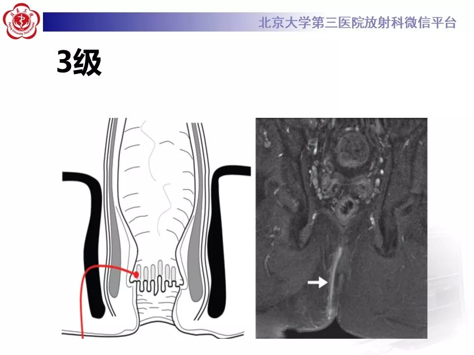 影像PPT - 【PPT】肛瘘-30