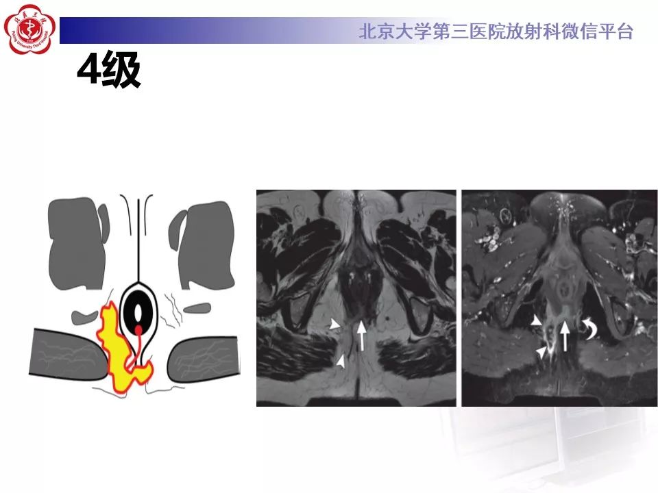 影像PPT - 【PPT】肛瘘-31