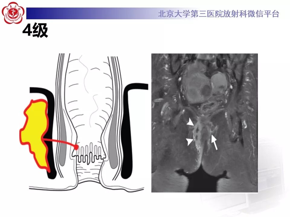 影像PPT - 【PPT】肛瘘-32