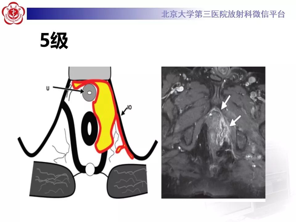 影像PPT - 【PPT】肛瘘-33