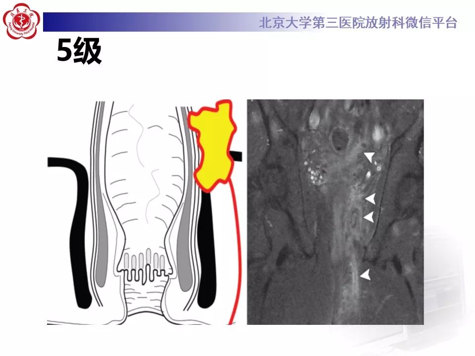 影像PPT - 【PPT】肛瘘-34