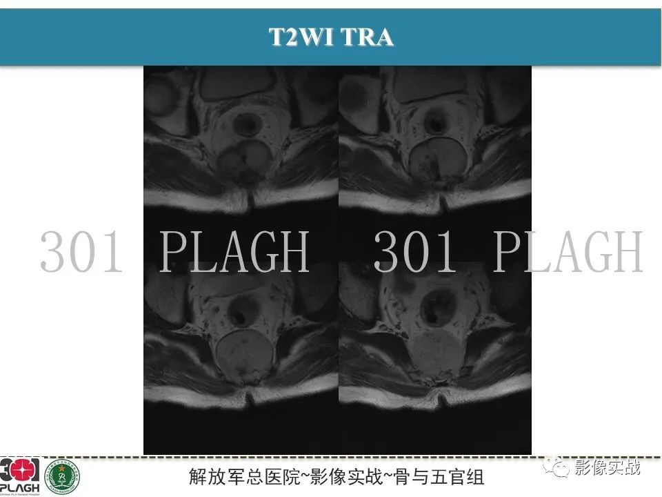 影像PPT - 【病例】骶尾部脊索瘤1例MR影像-7