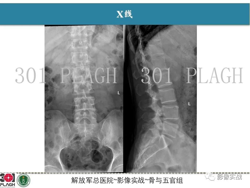 影像PPT - 【病例】骶尾部脊索瘤1例MR影像-3