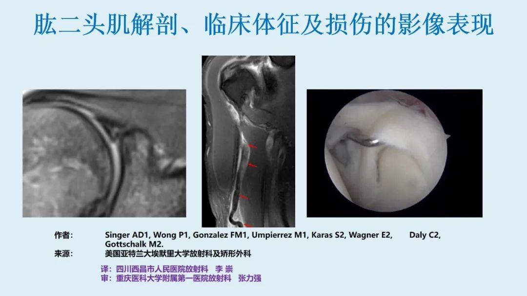 影像PPT - 【PPT】肱二头肌解剖、临床体征及损伤的影像表现-2 影像PPT - 【PPT】肱二头肌解剖、临床体征及损伤的影像表现-2