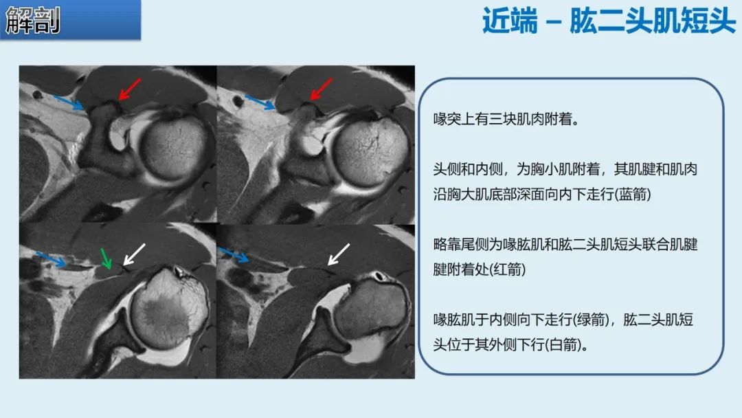 影像PPT - 【PPT】肱二头肌解剖、临床体征及损伤的影像表现-14 影像PPT - 【PPT】肱二头肌解剖、临床体征及损伤的影像表现-14