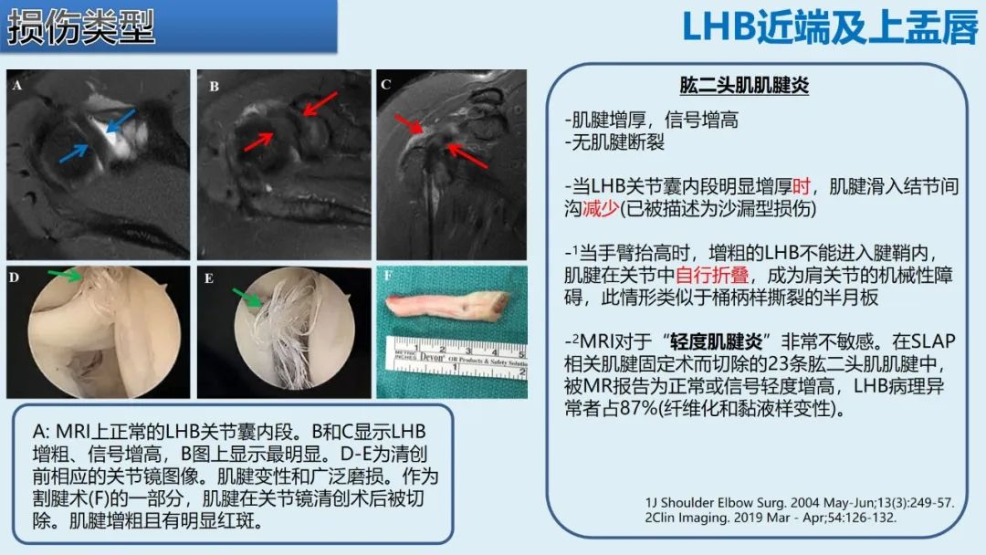 影像PPT - 【PPT】肱二头肌解剖、临床体征及损伤的影像表现-28 影像PPT - 【PPT】肱二头肌解剖、临床体征及损伤的影像表现-28