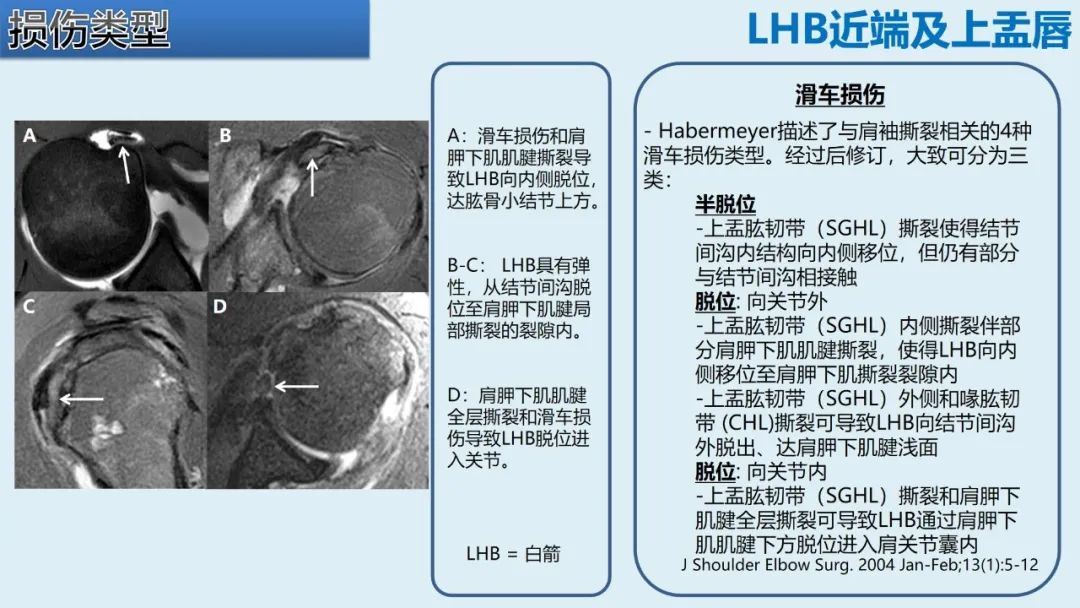 影像PPT - 【PPT】肱二头肌解剖、临床体征及损伤的影像表现-30 影像PPT - 【PPT】肱二头肌解剖、临床体征及损伤的影像表现-30