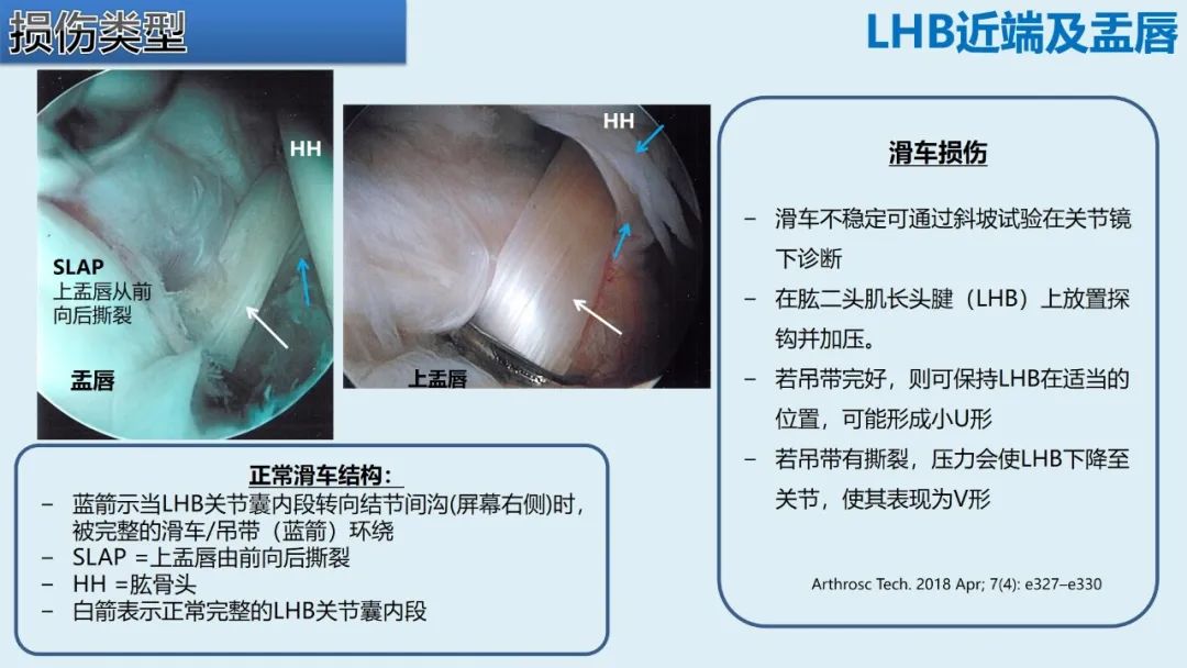 影像PPT - 【PPT】肱二头肌解剖、临床体征及损伤的影像表现-32 影像PPT - 【PPT】肱二头肌解剖、临床体征及损伤的影像表现-32