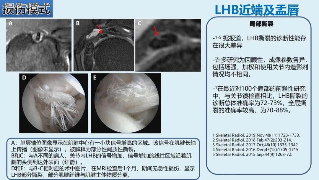 影像PPT - 【PPT】肱二头肌解剖、临床体征及损伤的影像表现-38 影像PPT - 【PPT】肱二头肌解剖、临床体征及损伤的影像表现-38