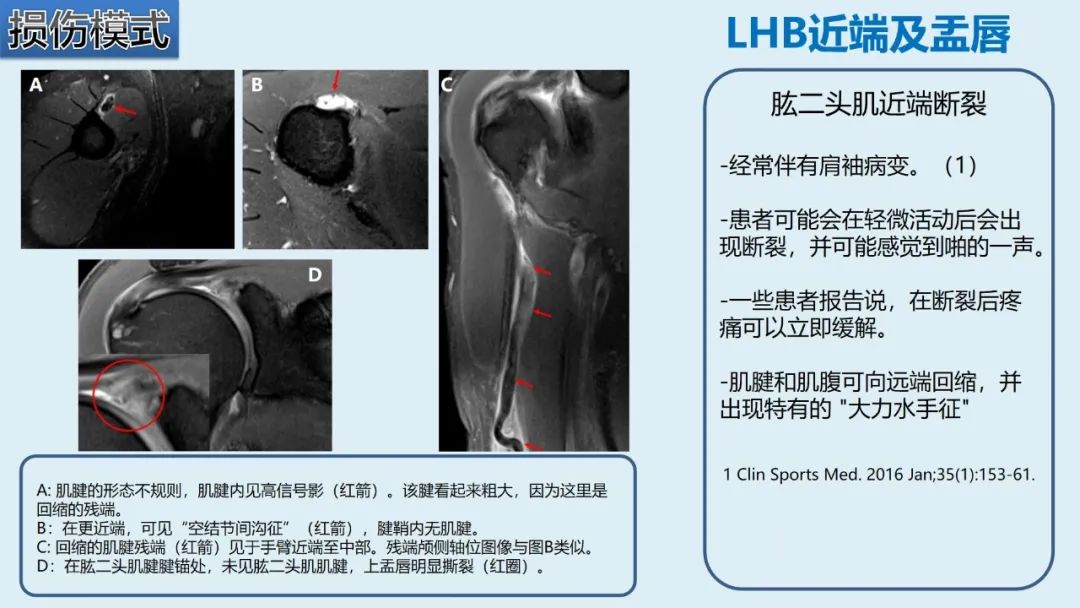影像PPT - 【PPT】肱二头肌解剖、临床体征及损伤的影像表现-40 影像PPT - 【PPT】肱二头肌解剖、临床体征及损伤的影像表现-40