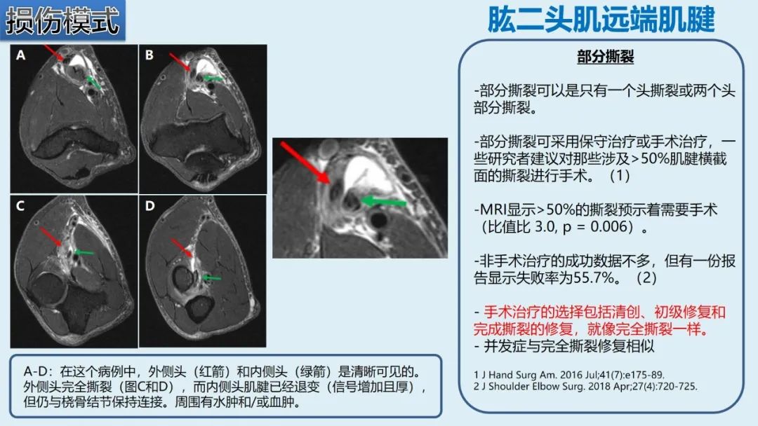 影像PPT - 【PPT】肱二头肌解剖、临床体征及损伤的影像表现-42 影像PPT - 【PPT】肱二头肌解剖、临床体征及损伤的影像表现-42