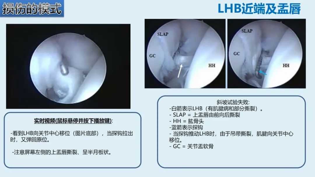 影像PPT - 【PPT】肱二头肌解剖、临床体征及损伤的影像表现-34 影像PPT - 【PPT】肱二头肌解剖、临床体征及损伤的影像表现-34