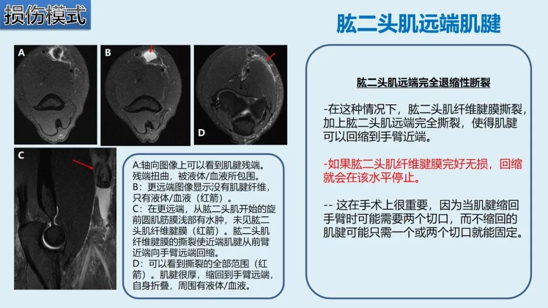 影像PPT - 【PPT】肱二头肌解剖、临床体征及损伤的影像表现-44 影像PPT - 【PPT】肱二头肌解剖、临床体征及损伤的影像表现-44